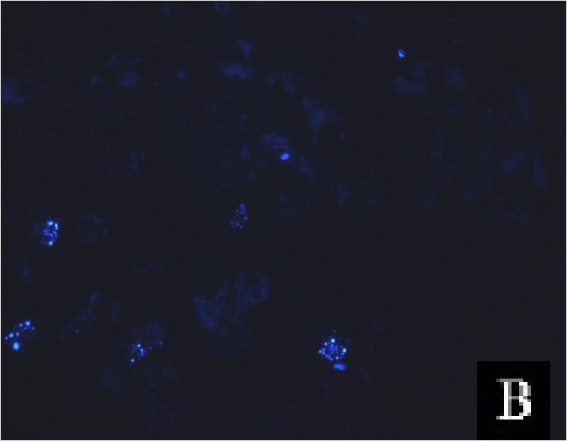 hücreleri, (B) 25 nm ABCE1 sirna ve 1 µm 5-FU + 1 µm irinotecan ile etkileştirilmiş A 549 hücreleri. Oklar apoptotik hücrelerden bazılarını göstermektedir.