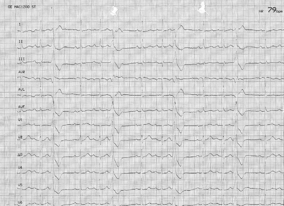 40 Türk Aritmi, Pacemaker ve Elektrofizyoloji Dergisi Giriş Ellibir yaşında bayan hasta çarpıntı yakınması ile kliniğimize başvurdu.