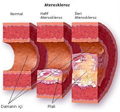 KARDİYOVASKÜLER HASTALIKLAR Ateroskleroz: