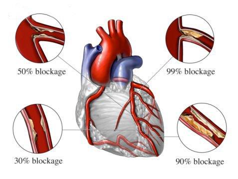 KARDİYOVASKÜLER HASTALIKLAR Kalp Krizi: Kalp kasına oksijence zengin kanı taşıyan bir