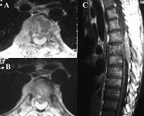 di. Spinal tümörlerin spinal kanaldaki yerleşimleri incelendiğinde 44 hastada (%46.80) tümör ekstradural yerleşimli (Resim 3), 34 hastada (%36.