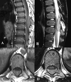 intradural intramedüller yerleşimli olduğu görüldü. Metastatik tümörlerin biri hariç tümü ekstradural yerleşimliydi.