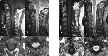 A ve B preoperatif sagital, C ve D preoperatif aksiyel MR görünümü Resim 5.