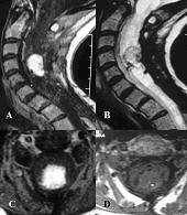 Resim 8. C4-C5 intradural intramedüller kitle (hemanjioblastoma). A ve B preoperatif sagital, C ve D preoperatif aksiyel MR görünümü.