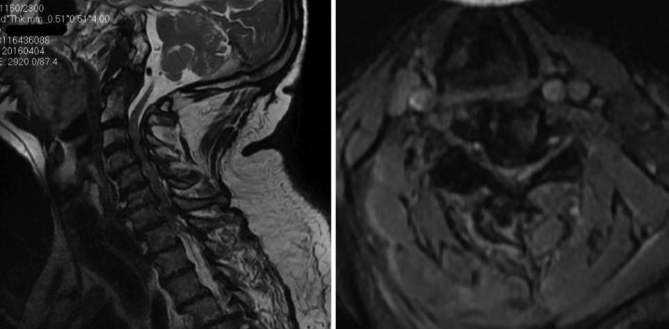 34 Tetraplejik Spondilotik Miyelopati Turk J Osteoporos 2017;23:33-8 ileri derecede dejenerasyon, C2-C3, C7-T1 düzeyleri arasında multipl disk protrüzyonu, kord kompresyonu ve bu düzeylerde spinal