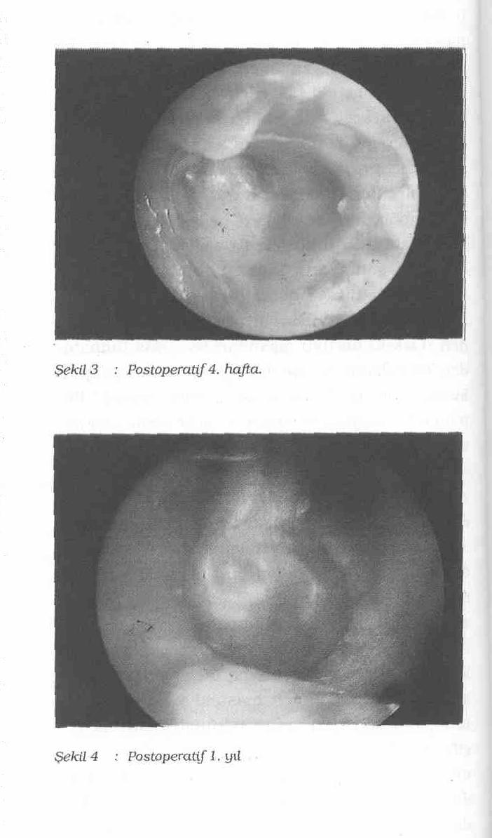 K.B.B. ve Baş Boyun Cerrahisi Dergisi, 3 :202-206,1995 GEREÇ ve YÖNTEM : 1977-1994 yılları arasında Hacettepe Üniversitesi Kulak Burun Boğaz Anabilim Dalında radikal mastoidektomi ve aynı seansta