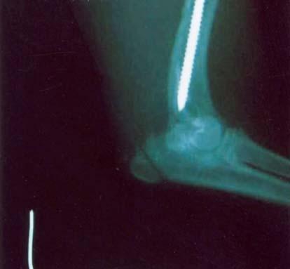 kötü: ekstremitesini hiç kullanamama ve kalıcı topallık şeklindeydi. Şekil 2. Olgu no: 14 ün postoperatif M/L radyografik görünümü. Figure 2. Postoperative radiographic M/L view of Case no: 14.