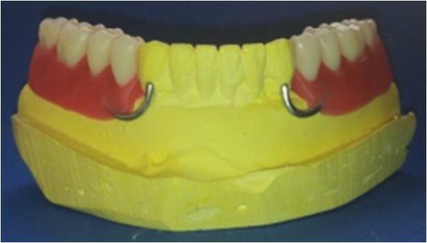İmplant Üstü Hareketli Bölümlü Protezlerin Hareketli Komponentlerinin Diş