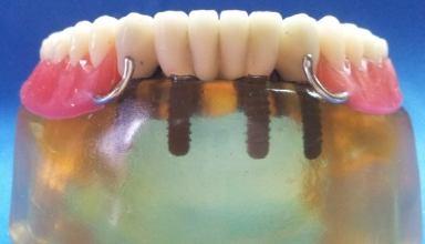 Diş dizimlerini standardize etmek için, silikon indeksler hazırlandı ve diş