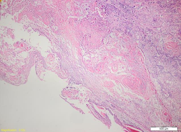 Çoğu alanda lenfatikler içerisinde tümör trombüsleri görüldü.