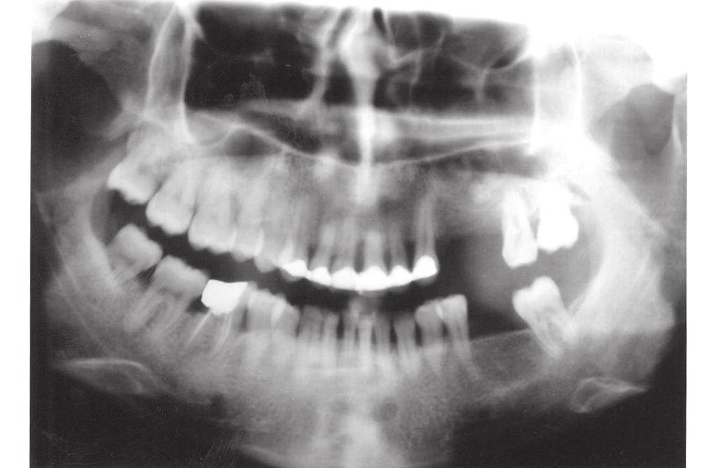 Sinüs membranı ile sinüs tabanı arasına mandibuler simfizis bölgesinden alınan otojen kemik grefti yerleştirildi (Resim 3a,3b-4).