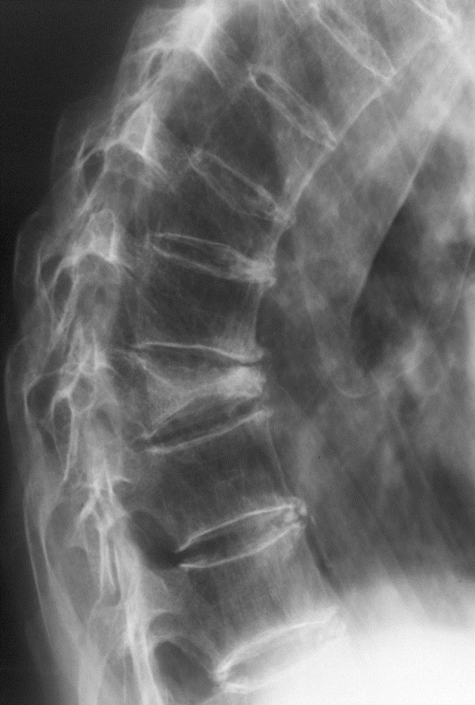 Lateral torako-lumbar vertebra X-ray Kama şeklinde vertebra kırığı Vertebral kompresyon kırığı Vertebral görüntüleme Düşük travma