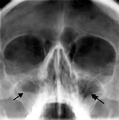 Akut Rinosinüzitte : Tanı Radyografi : Oksipitomental (Waters) Oksipitofrontal (Caldwell) Lateral Submentovertikal