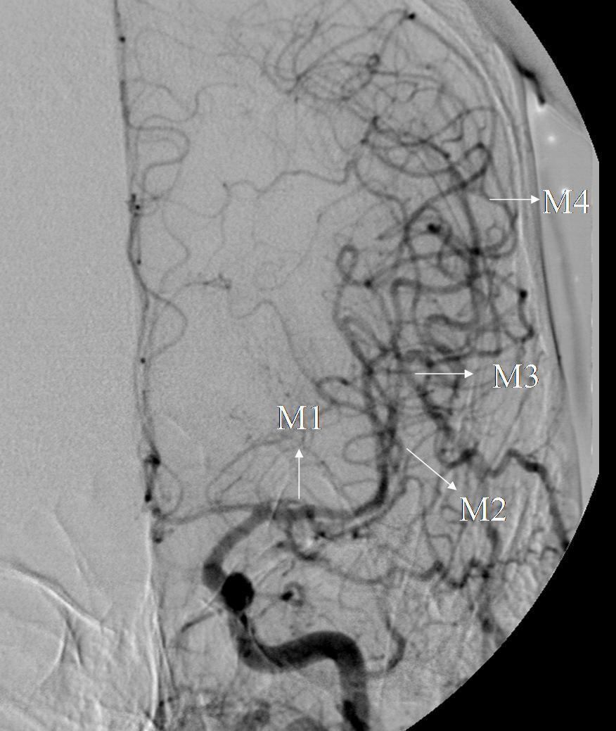 2.1.4. Orta Serebral Arter Đki terminal ICA dalından büyük olanıdır. MCA anevrizma ve vasküler varyasyonların sık görüldüğü bir damardır.