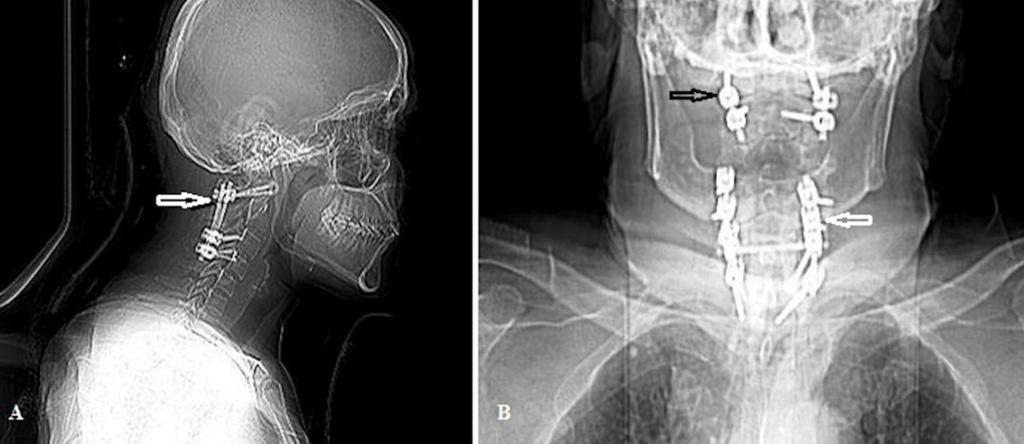Özay ve ark. Cukurova Medical Journal Resim 3. A: Direkt yan grafide C1-C3-C4 vertebraların lateral kitlelerine yerleşimli vidalar ve posterior segmental stabilizasyon bulguları görülüyor.
