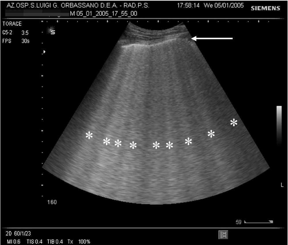 Ant oblig akciğer görüntüsü B çizgileri olarak tabir edilen çok sayıda dikey ekojenik artefakt.