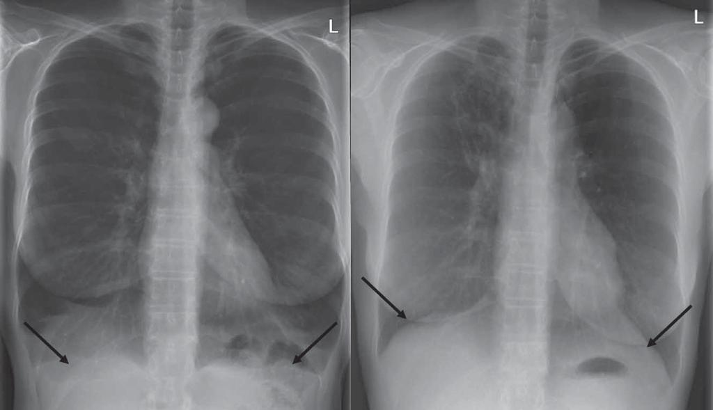 a b Resim 5. Weder ve ark (25/ a) preoperatif akciğer grafi si b) 7.