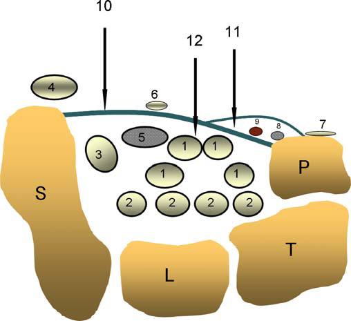 Şekil 5. El bileği volar yüz proksimal düzeyi kesiti (7) S: skafoid, L: lunat, T: triquetrum, P: pisiform, 1.