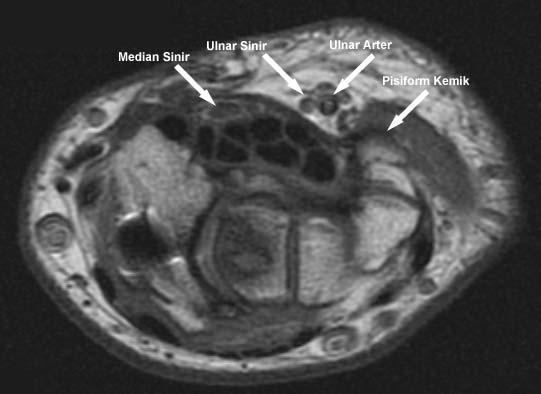 fleksör carpi radialis tendonu, 5. median sinir, 6. palmaris longus, 7. fleksör carpi ulnaris, 8. ulnar sinir, 9.