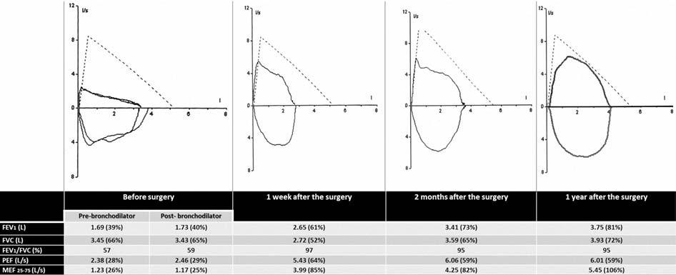 Oesophageal achalasia misdiagnosed as uncontrolled asthma Achalasia is characterized by incomplete lower oesophageal sphincter relaxation and aperistalsis of the oesophagus.