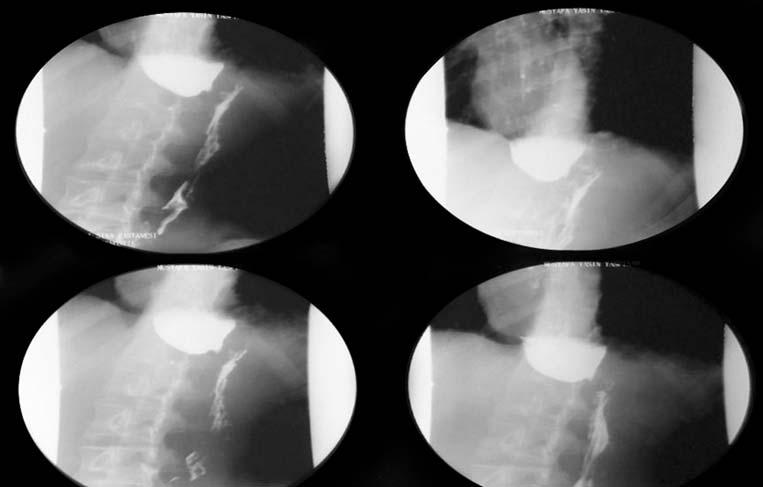 Oesophageal achalasia misdiagnosed as uncontrolled asthma Figure 4. Barium-oesophagogram of the patient. sphincter is unable to relax and there is no peristaltism along the oesophagus.