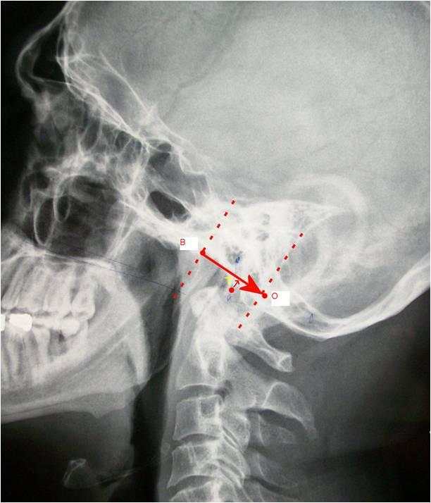 42 McRae s çizgisi ile dens axis in tepe noktası arasındaki mesafe ölçüldü (Şekil 19 da BO-T mesafesi).