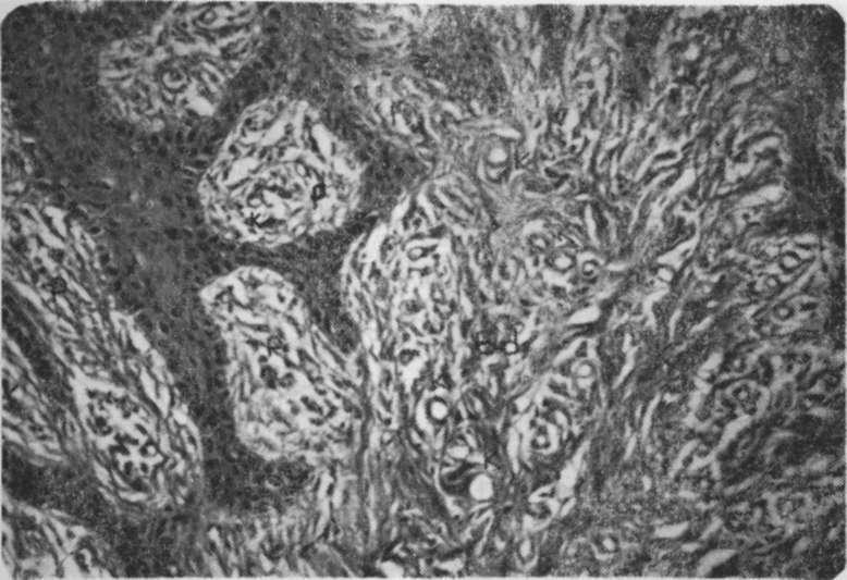 N. Yamalık, L. Delil'.'aşı, H. Gülay, F. Çağlayan, M. Haberal, G. Çağlayan hücrelerin çoğunlukta olduğu gözlenmiştir (Resim 8).