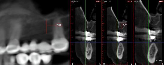 40 GİRİŞ Posterior maksiller bölgede implant uygulamaları, maksiller sinüsün anatomik konumu ve çok trabeküllü alveol kemiğine bağlı olarak klinisyenlere önemli sorunlar yaratabilir.