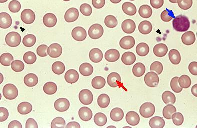 Hemoliz LAB bulguları LDH düzeyi = Artmış Haptoglobin düzeyi = Düşük Retikülositoz İndirekt biluribin