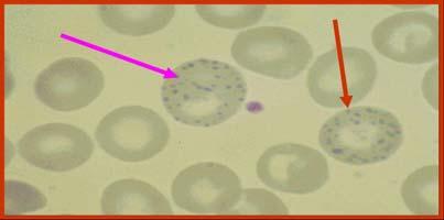 hemoliz durumlarında eritroblastlar, seforositler veya şiştozitler görülebilir Normal Periferik Yayma