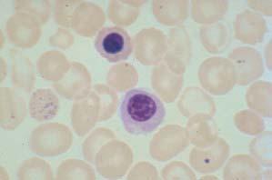 Herediter sferositoz, OİHA, diğer bazı hemolitik anemiler Bazofilik noktalanma Post-splenektomi Kurşun