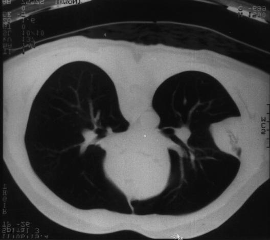 130 CERRAHPAŞA TIP DERGİSİ Cilt (Sayõ) 33 (2) mü ne başvurdu. Hastanõn özgeçmiş ve soy geçmişinde bir özellik saptanmadõ. Asbestoz ilişkisi ve sigara kullanõmõ öyküsü yoktu.