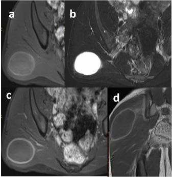 10 yaşında erkek hasta; sol kol distalinde (a) T1A YB aksiyal görüntülerde kas ile izointens ve hiperintens komponentleri olan (b) T2A aksiyal görüntülerde hiperintens heterojen (c) IVKM sonrası