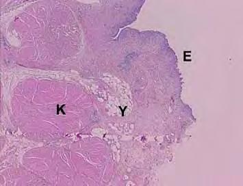 Resim 7. Lamina propriada yağ infiltrasyonuna örnek. Yüzey epiteli (E) ve müskülaris propria (K) arasında yağ dokusu (Y) izleniyor Resim 8. Kesintili müskülaris mukozaya örnek.
