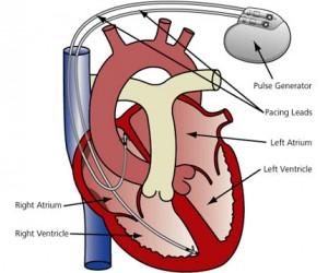 lead (sağ atrium ve sağ ventriküle) yerleştirilir (17). Eğer operatör sağ atriyuma elektriksel iletinin ulaşmasını amaçlıyorsa, sağ atriyuma bir elektrot yerleştirir (Şekil 9).