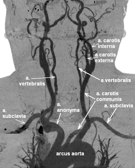 Beynin Kanlanması Beyin arcus aorta ve dallarından ayrılan karotis ve vertebral arterler aracılığı ile beslenir.