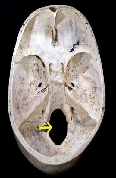 Medulla spinalis, foramen magnum seviyesinde bulbusun alt