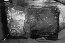 Flebin distal kısmına epitel örtüsü için supraklavikular bölgeden alınan 0 X 6 cm lik deri grefti kondu. Flep kenarları 4/0 nylon ile sütüre edildi.