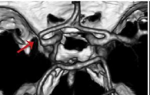 BBTA 15 sn gibi bir sürede intrakraniyal ve ekstrakraniyal damar yapılarını içeren nörovaskuler ağacın anatomik