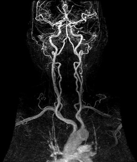Contrast Enhanced MRA Duyarlılığı ince damarlarda daha yüksek Vertebral arter görüntülemede