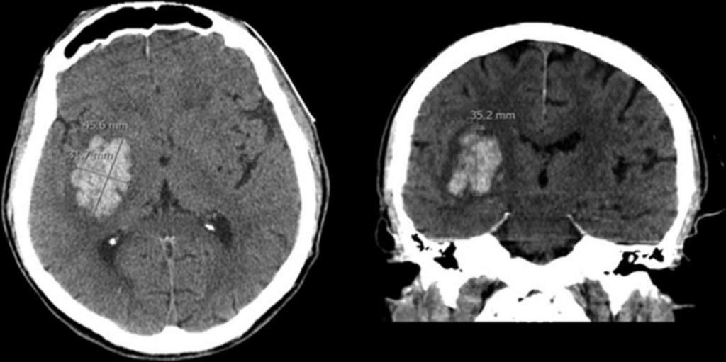 Intracerebral hemorrhage evidenced on CT (ABC/2 formula by CT). arrows).