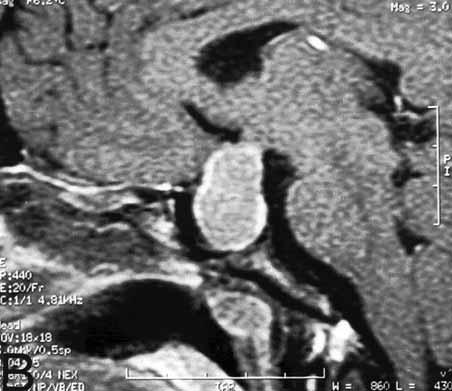 4 olup en sık anterior sirkülasyon anevrizmaları görülmektedir (1,5,6,7,8,9,12,13,14, 15). Bu birliktelik yaş faktöründen dolayı değişkenlik gösterir.