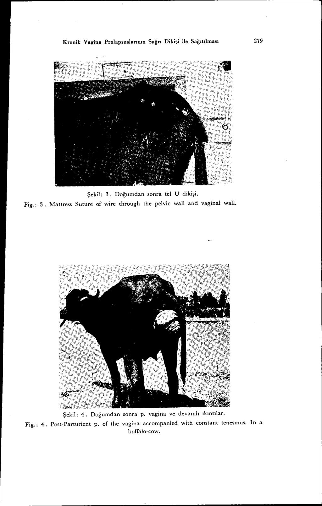 Kronik Vagina Prolapsuslannın Sağrı Dikişi ile Sağıtılması 279 Şekil: 3. Doğumdan sonra tcl U dikişi. Fig.: 3. Mattress Suture of wire through the pclvic waıı and vaginal walı.