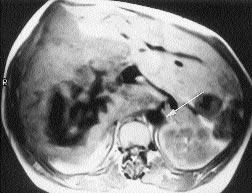 Karaci er düzeyinde inferior vena kava komprese görünümdedir (çift ok). B.