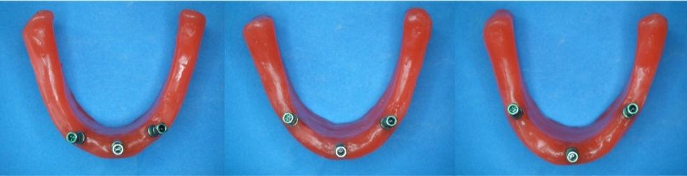 Resim 3: İmplantların mum modellere yerleştirilmesi Mum modeller üzerinde implantların yerleştirileceği kısımlar işaretlenmiş ve parelelometre kullanılarak implantlar yerleştirilmiştir.