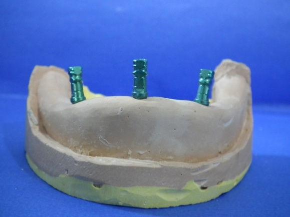 Resim 10: İmplantüstü protezlerin yapımı için model elde edilmesi Modellerde serbest sonlanan kısımlara 3 mm kalınlığında hazırlanan basplak, mumla (Modelling Wax, Dentsply, ABD) sabitlenmiştir 40.