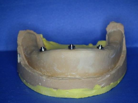 Resim 11: Basamaklı abutment'ların modelde yerleştirilmesi Plastik prefabrik barlar implantlar arasındaki mesafeye uygun olarak kesildikten sonra, plastik dökülebilir