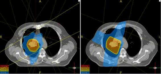 4. BULGULAR Akciğer kanseri tanılı 10 hastanın 3BKRT ve YART tekniği ile tedavi planlamalarından elde edilen doz hacim histogramlarından yararlanarak hedef hacim, sağ ve sol akciğerler, kalp, spinal