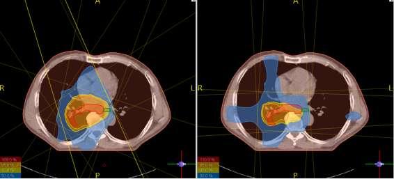 Sağ akciğer orta loba yerleşmiş PTV için 4 alanlı 3BKRT ve 6 alan 4 segment YART planlaması sonucu elde edilen transvers, sagittal ve
