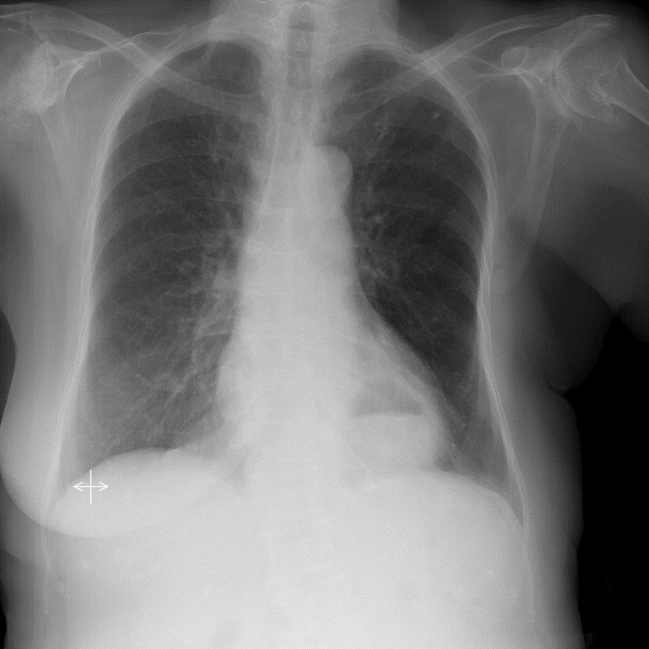1 Tek taraflı hiperlüsent akciğer (opere meme ca), hiatal herni (kalb arkasında herniye mideye ait hava